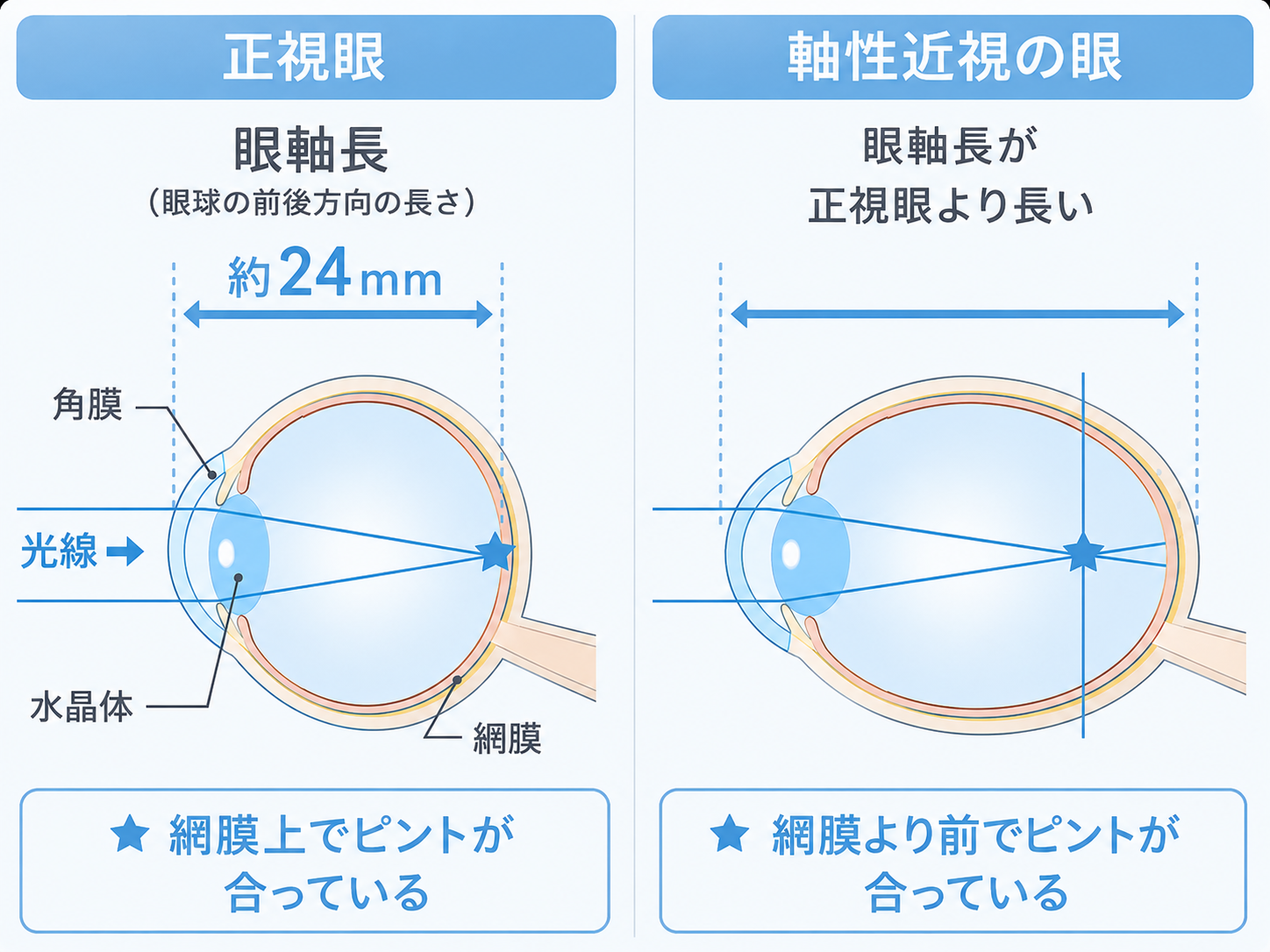 近視は「眼軸長」が伸びることで進行しますの図解